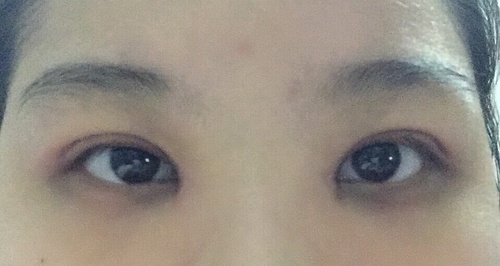 最新双眼皮流行趋势引领美丽变革，打造迷人双眼皮魅力！